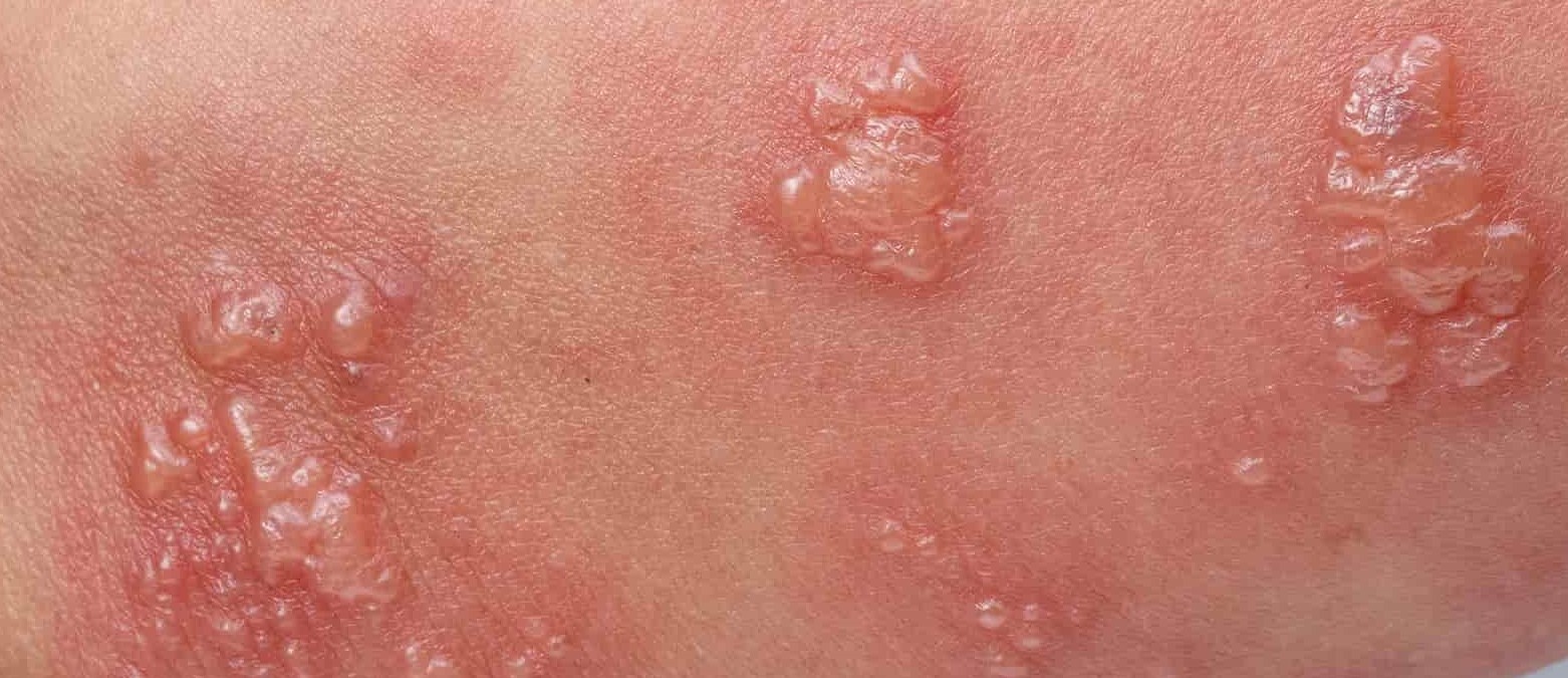 Clusters of herpes sores